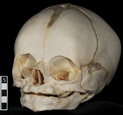 infant skull
